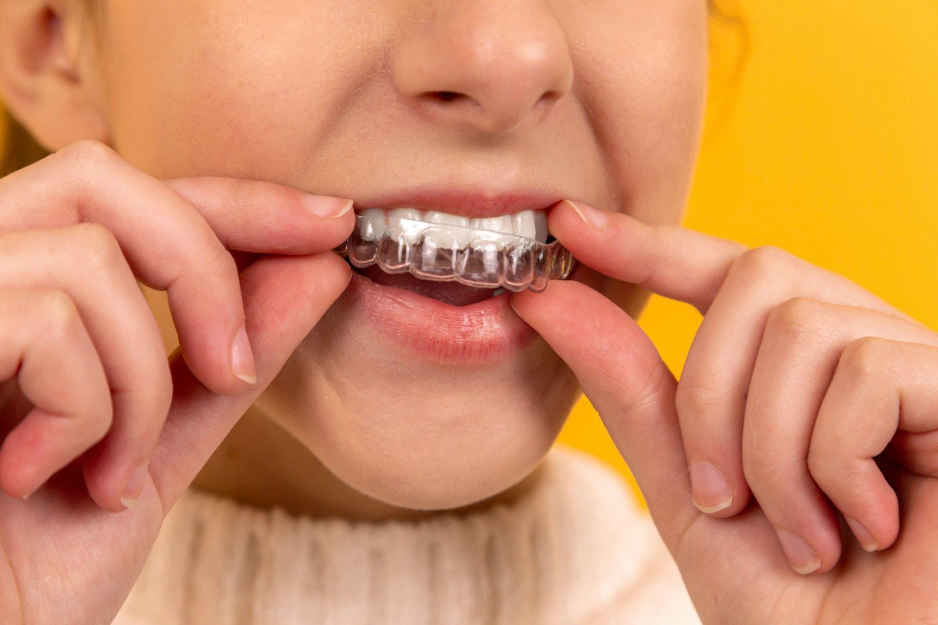 Czym jest system Invisalign stosowany w ortodoncji?